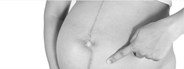 HOW TO PREVENT STRETCH MARKS IN PREGNANCY